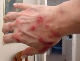 Papul on the skin with helminthiasis
