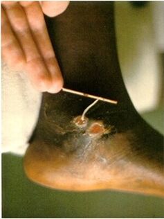 Guinea worms are extracted from the leg of a person suffering from dracunculiasis